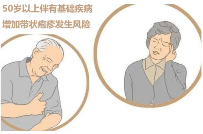 带状疱疹(急性感染性皮肤病)