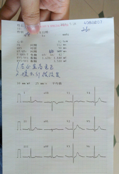 左室高电压(循环系统器质性疾病等引起的现象)
