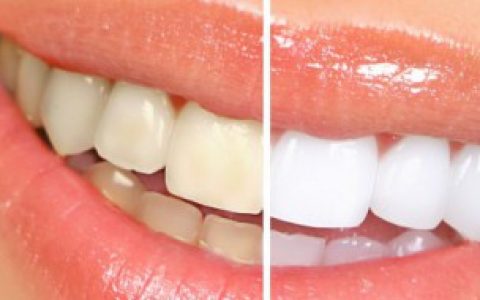 【如何清理牙缝污渍】怎么清理牙缝污渍