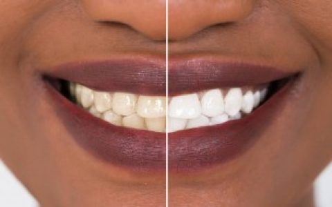 【多久洗一次牙比较好】洗牙多久一次